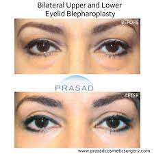 upper eyelid surgery