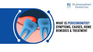 what is pericoronitis