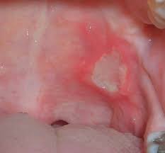 ten causes of canker sores answers