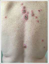 atypical rash in an hiv infected