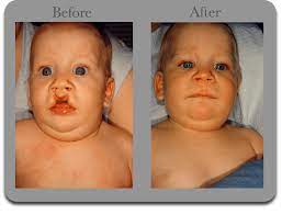 cleft lip palate top hair transplant