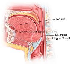lingual tonsillectomy sleep doctor