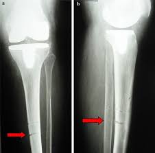 tibial stress fracture after computer