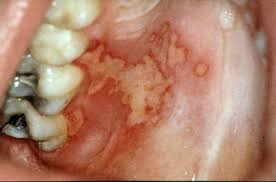 aids recur herpes lesions of the