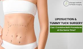 liposuction tummy tuck surgery can