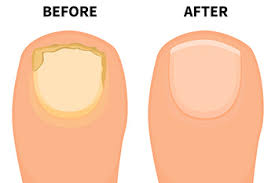 toenail fungus treatment in charlotte