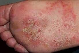 foot eczema causes symptoms