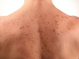 brown spots may dermatology