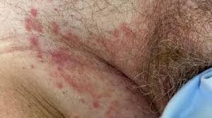 armpit rash 14 possible causes and how