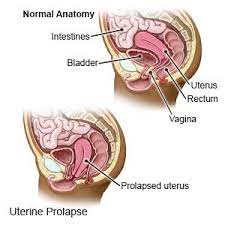 uterine prolapse what you need to know