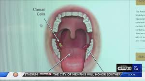 Throat cancer often affects people between the ages of 50 to 70 and predominantly affects the male gender. Local Health Alert Hpv Directly Related To Throat Cancer Doctors Urge Vaccination Localmemphis Com