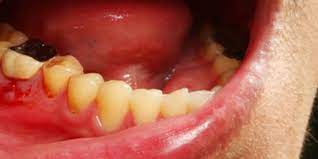 gum disease san francisco marin