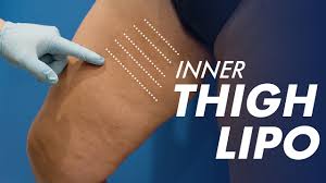 liposuction in the inner thigh