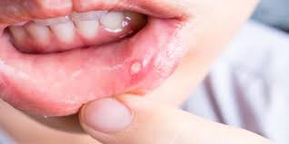 mouth ulcer treatment chennai