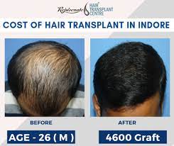 cost of hair transplant in indore