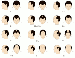 Norwood Scale How Bald Are You Norwood Scale 2 Examples