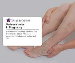 painful leg veins during pregnancy