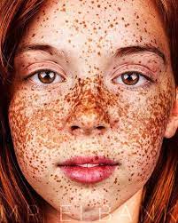redheads have freckles