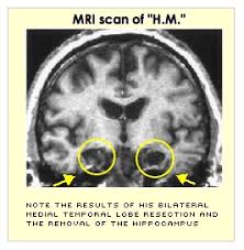 Patient H M  Dark Roots and Dubious Ethics  Neuroscience Research     Neurological Studies H M  case