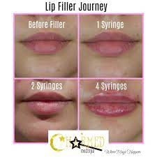 one two or four syringes filler lip