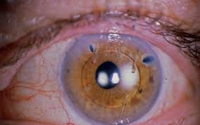 intraocular lenses for cataract surgery
