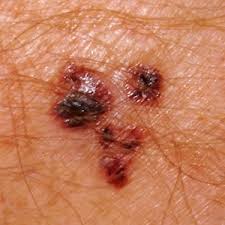 Find out how to spot the early signs of skin cancer. Nhs Video Symptoms Skin Cancer Skin Surgery Laser Clinic