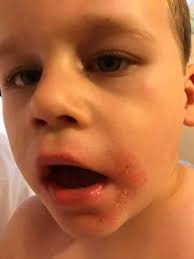 bad rash round child s mouth