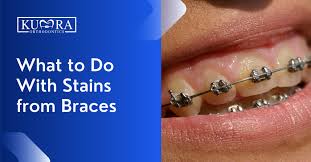 stains from braces treatment and