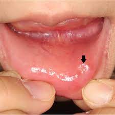 a photograph of the lower lip lesion