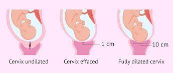 cervical effacement and dilatation in