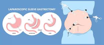 gastric sleeve sleeve gastrectomy