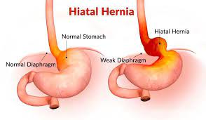 hiatal hernia csf surgery