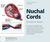 Image result for icd 10 code for tight nuchal cord