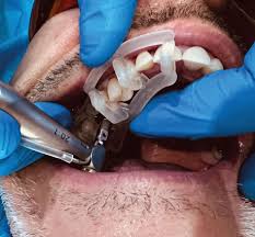 dental implant success