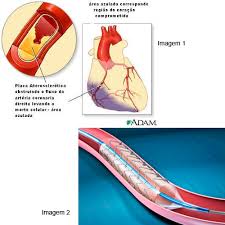 Os enfartes do miocárdio silenciosos podem ocorrer sem qualquer sintoma. Hci Hemodinamica E Cardiologia Invasiva Ver Artigo