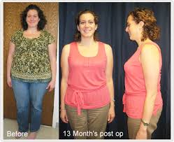 gastric byp before after