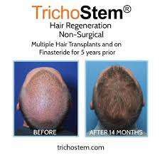 why is finasteride not working dr