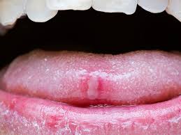 tongue ulcer how to identify symptoms