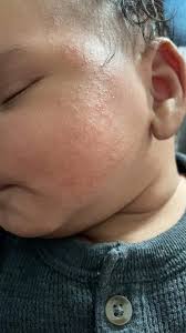 tips for feeding es with eczema