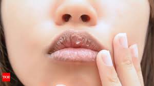 chapped lips using home remes