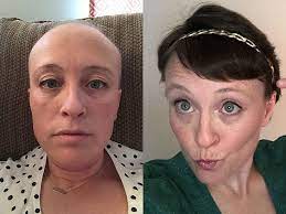 52 photos of hair loss and recovery