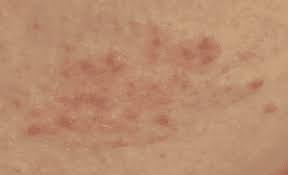 eczema scars how to treat them waxelene