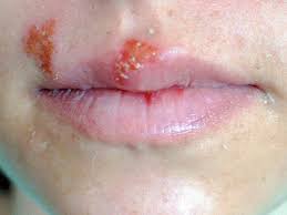 cold sore on lip pictures treatments