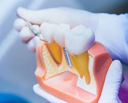 Dental Implant Procedure in Fairfax, VA | Affordale Options