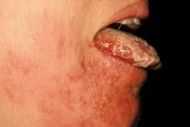 what shingles in the mouth looks like