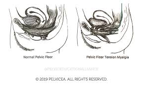 uncovering the pelvic floor tension