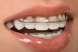 The overlapping often leads to plaque and calculus buildup that leads to malodor, cavity formation and gum disease too. Are There Any Natural Ways To Get Teeth Straighten Without Getting Braces Quora