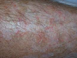 what an hiv rash looks like 9 types