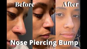 how to get rid of a nose piercing p