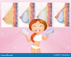 Breast Implants Stock Illustrations – 117 Breast Implants Stock  Illustrations, Vectors & Clipart - Dreamstime